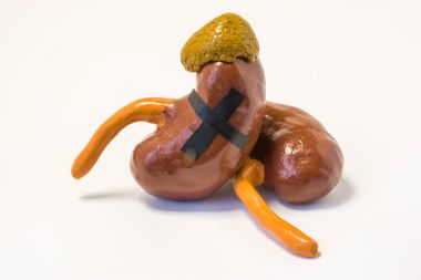 Anatomical model of the kidneys and adrenal glands pasted a big black cross on them. Concept photo signifying failure kidney function or adrenal hormonal insufficiency, organ death, terminal illness clipart
