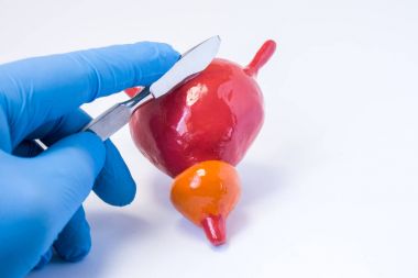 Mesane Cerrahi operasyon kavramı fotoğraf. El, neşter tutan doktor cerrah, idrar kesesi anatomik model keser. Başta ameliyat ne zaman idrar kesesi için idrar kaçırma, kanser ya da cystocele