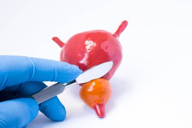 Prostat bezi cerrahisi prosedürü veya cerrahi operasyon fotoğraf kavramı. El cerrahı bir neşter ile prostat ve mesane anatomik modelidir. Prostat bezi ameliyat illüstrasyon