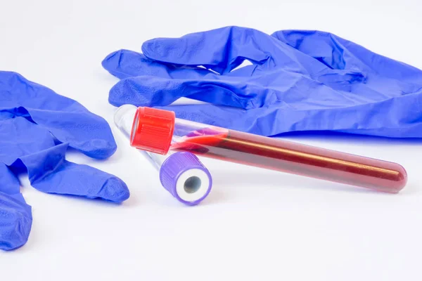 Dos Probetas Laboratorio Con Muestras Sangre Plasma Otros Fluidos Biológicos — Foto de Stock