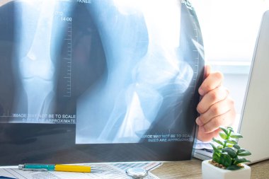 Doktor, iş ve hasta muayenesi sırasında bilgisayarın yanında dizin röntgenini inceler. On-ray açıkça gösteriyor ki hem diz ekleminin hem de dizkapağının anatomik eklemleri...