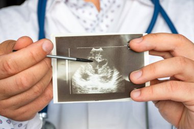 Ultrason görüntüsü fotoğrafında kalp ventriküler genişleme. Kalp ventriküler genişlemesinin ultrason patolojisinin basılı resmine işaret eden doktor. Teşhis, radyoloji, kardiyoloji için.