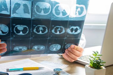 Doktor, göğüs ve karın boşluğunun tomografisini inceler ve inceler. Pulmonolojide hastalıkların teşhisi, akciğer patolojisi, bronşların iltihaplı hastalıkları, tüberküloz konulu konsept fotoğraf