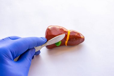 Kolesistektomi ameliyatı, safra kesesi ameliyatı ya da safra kesesi ameliyatı fotoğrafı. Doktor elinde tutuyor, ameliyat eldiveni giymiş, neşteri anatomik figür safra kesesi karaciğerinin üzerinde. 