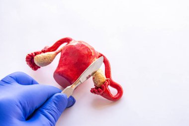 Ovarektomi ya da ooforektomi fotoğrafı konsepti. Toplam ya da parça yumurtalık ameliyatı ya da kadın ameliyatı. Doktor elinde tutuyor, ameliyat eldiveni giymiş yumurtalıkların anatomik figürünün üzerinde neşter taşıyor.