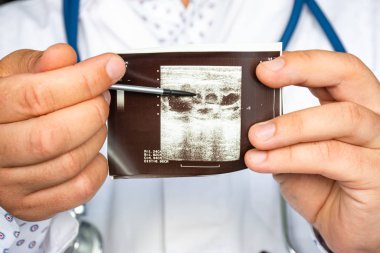 Ultrason görüntüsü fotoğrafında hidronefroz. Doktor, böbreğin ultrason patolojisinin hidronefroz gibi basılı resmine işaret ediyor. Teşhis, radyoloji, nefroloji, ameliyat için.