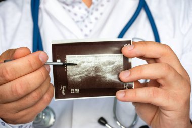 Ultrason görüntü konsepti fotoğrafında kalça bölgesine kas içi enjeksiyondan sonra apse. Doktor, ultrason patolojisi sonrası apselerin basılı resmine işaret ediyor.