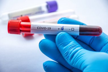 Coronavirus veya COVID-19 konsept fotoğraflarının laboratuvar teşhisi. Doktor laboratuvar teknisyeninin elinde, üzerinde kan olan tüp ve pozitif test sonuçlarını gösteren COVID-19 işaretli yakın çekim çerçevesinde.