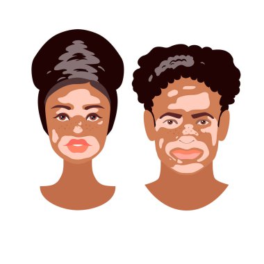 Güzel Afrikalı genç kadın ve erkek Vitiligo bozukluk dokusu ile karşı karşıya. Cilt durumu melanin kaybına neden olur. Oğlan ve Kız kafaları beyaz arka planda izole edilmiş. Stok vektörü düz illüstrasyon