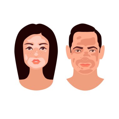 Güzel Avrupalı genç kadın ve erkek Vitiligo bozukluğuyla karşı karşıya. Cilt durumu melanin kaybına neden olur. Oğlan ve Kız kafaları beyaz arka planda izole edilmiş. Stok vektörü düz illüstrasyon