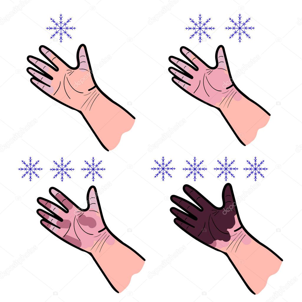 set of four hand drawings on a white background stage of frostbite vector illustration