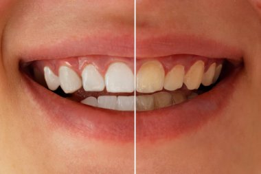 Öncesinde diş beyazlatma. Kadın dişleri beyazlamadan önce ve sonra. Diş sağlığı konsepti. Oral bakım kavramı