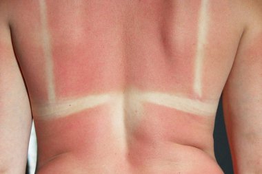 Sonra güneş yanığı yanmış geri