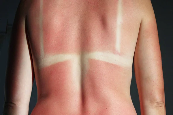 Burn from the sun on the body — Stock Photo, Image