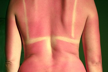 Sonra güneş yanığı yanmış geri