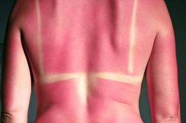 Back burnt after sunburn clipart