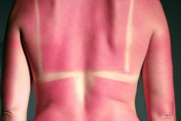 Back burnt after sunburn — Stock Photo, Image