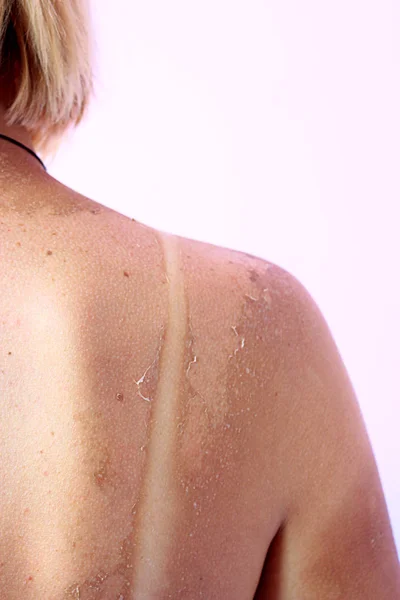 Back burnt after sunburn — Stock Photo, Image