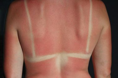 vücuttaki güneşten yanmak