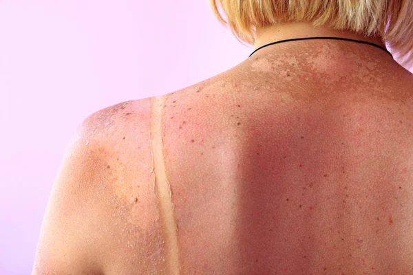 Vestígios de queimaduras solares nas costas de uma mulher. Corpo feminino — Fotografia de Stock