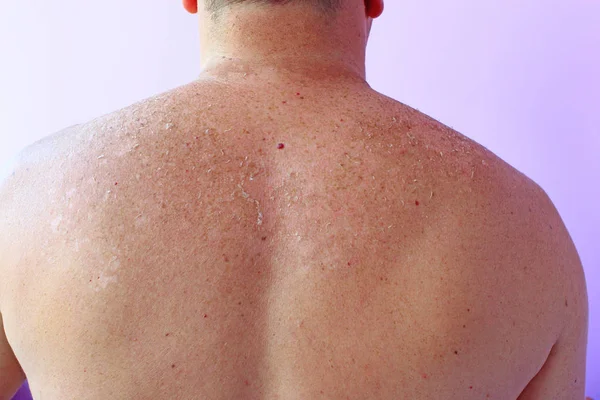 La piel trepando sobre la espalda del hombre después de tomar el sol. Piel humana después de tomar el sol — Foto de Stock