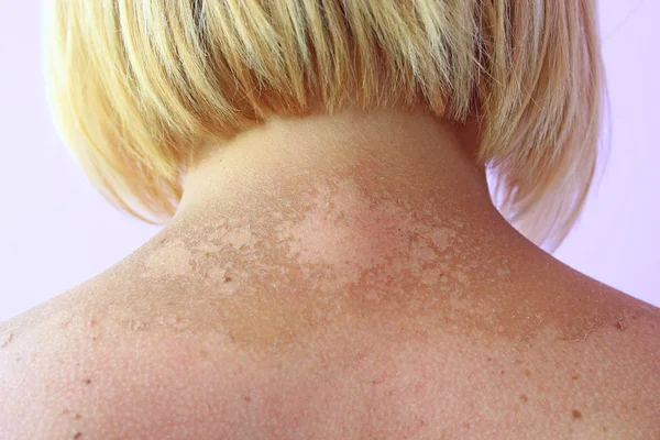 Neck burnt after sunburn. Female body — Stock Photo, Image