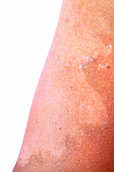 Huden klatrer rundt på en manns arm etter soling. Menneskelig hud etter soling – stockfoto