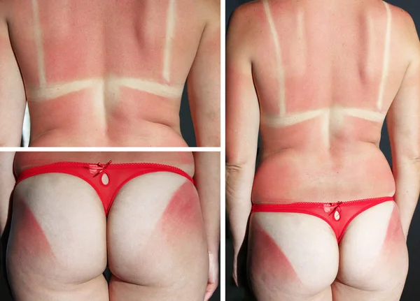 Nádegas e costas queimadas após queimadura solar — Fotografia de Stock