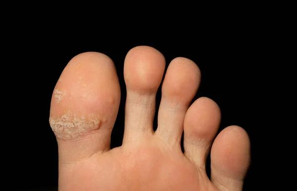 Κοντινό Πλάνο Των Ραγισμένων Δαχτύλων Ποδιών Του Ανθρώπινου Δέρματος Που — Φωτογραφία Αρχείου