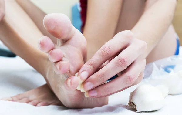 Ev yapımı ya da alternatif, verruca ya da plantar koğuşu için sarımsaklı doğal tedavi 
