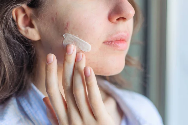 Una Ragazza Con Pelle Problematica Acne Applica Crema Sulla Sua — Foto Stock