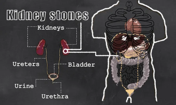 Kidney Stones illustration — Stock Photo, Image