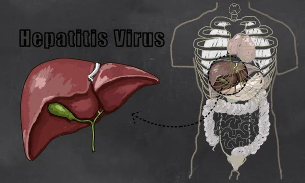 Гепатит хвороба ілюстрація — стокове фото