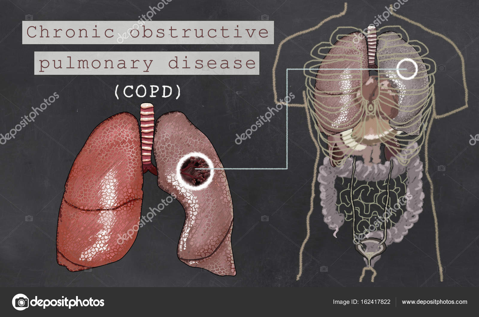 Chronic Obstructive Pulmonary Disease with Lungs Stock Photo by ©TLFurrer 162417822
