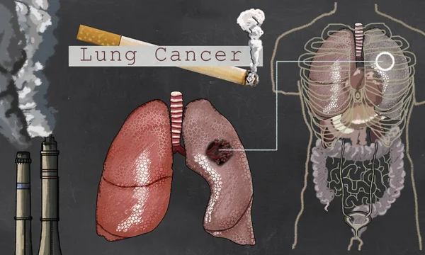 Рак легких, иллюстрированный в классическом стиле — стоковое фото