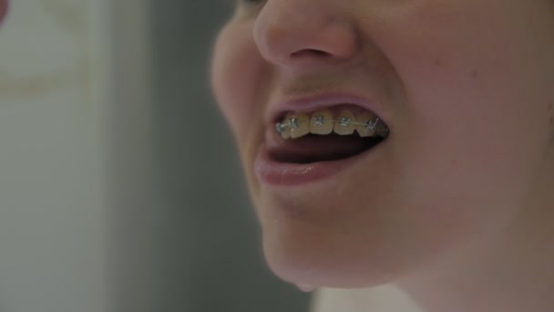 Dziewczyna czyści aparat na zęby — Wideo stockowe