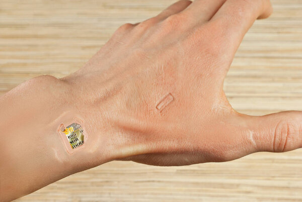 The chip is mounted under the skin. Chips embedding concept. Chip on wrist close up. Hand on scars after laser surgery.