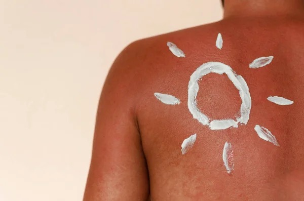 Skin sun burn on sea — Stock Photo, Image