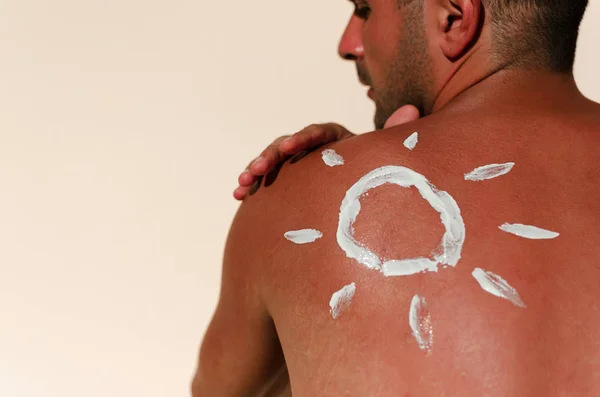 Sun burn male skin — Stock Photo, Image