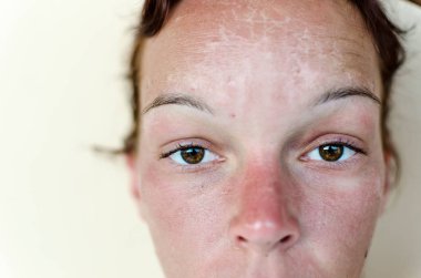 Sunburn and red skin clipart