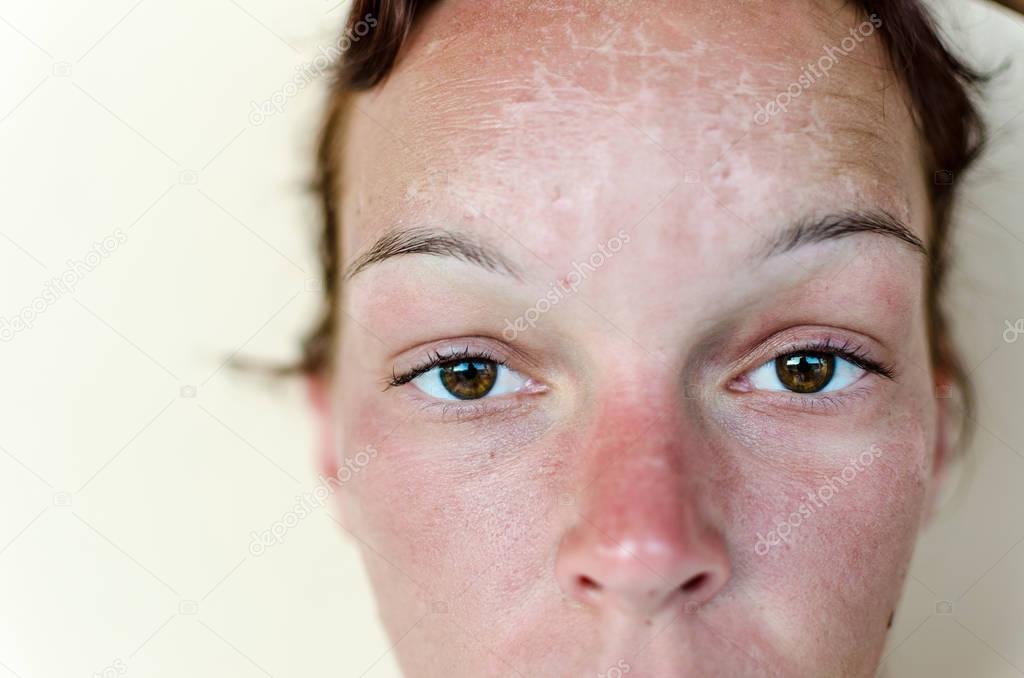 Sunburn and red skin