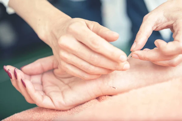 Geschnittenes Bild Von Frauen Die Eine Akupunkturbehandlung Handgelenk Haben Nahaufnahme — Stockfoto