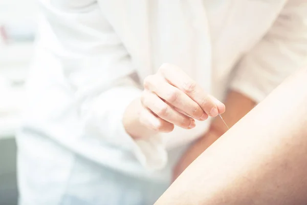 Nahaufnahme Der Hand Bei Der Akupunktur Arm Des Patienten Alternatives — Stockfoto