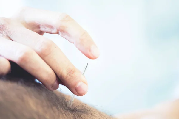 Beskuren Bild Arm Stickande Akupunktur Nål Del Manlig Kropp — Stockfoto