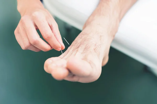 Przycięte Zdjęcie Igłą Akupunktury Nodze Mężczyzny — Zdjęcie stockowe