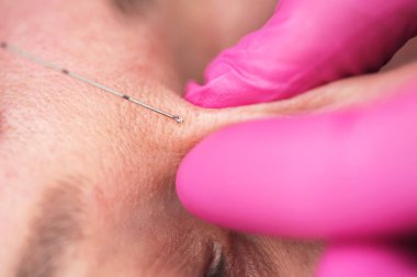 Kadın yüzü için dolgu iğnesi. Estetik yüz cerrahisi ve klinikte. Kadın doktorun kozmetoloji odasında iğne yaparken çekilmiş görüntüsü. Fotokopi alanı olan yakın plan resim. Şırınga iğneli tıp eldivenleri giyen doktor yenilenmek için botulinyum enjekte ediyor.