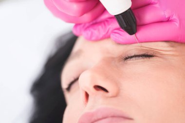 Göz kapaklarının derisini güçlendirmek için estetik ameliyat. Plazma IQ aparatında cerrahi olmayan blefaroplasti.