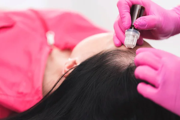 Vista Cerca Del Instrumento Microdermoabrasión Cosmética Derma Roller Para Cabello — Foto de Stock