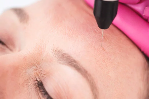 Cosmetische Procedure Huid Van Oogleden Versterken — Stockfoto