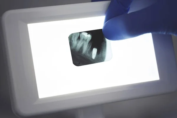 Cropped Picture Doctors Hand Dentist Holds Shot Black White Ray — Stockfoto